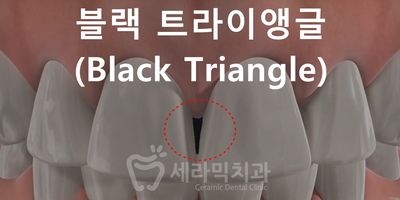 치아교정 부작용 3. 치아 사이 틈(블랙트라이앵글) 관련 이미지 1