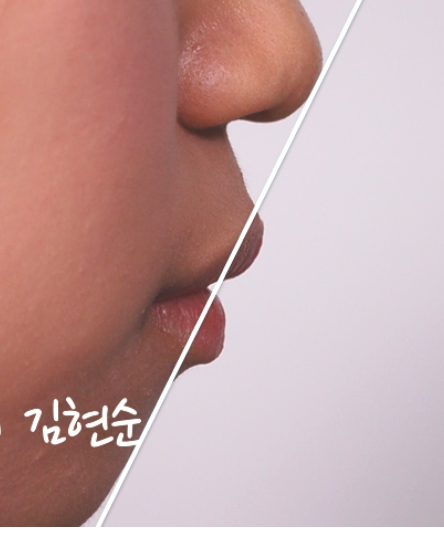 학동역치과 돌출입교정은 세라믹치과에서 관련 이미지 4