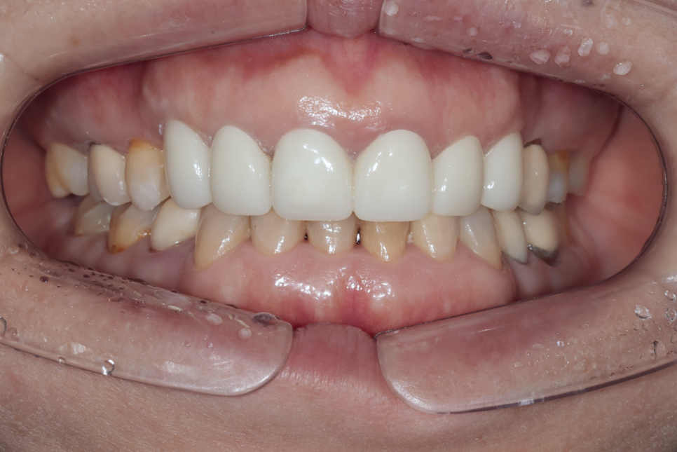 일본에서 거절당했던 앞니 심미보철 크라운 관련 이미지 12