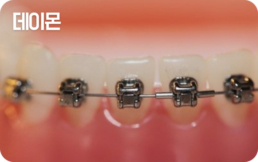 교정장치 구분하기 관련 이미지 7