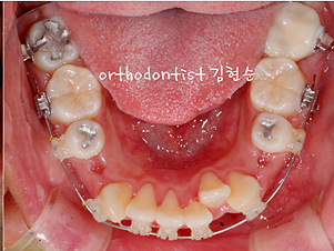 강남 돌출입 교정 관련 이미지 22