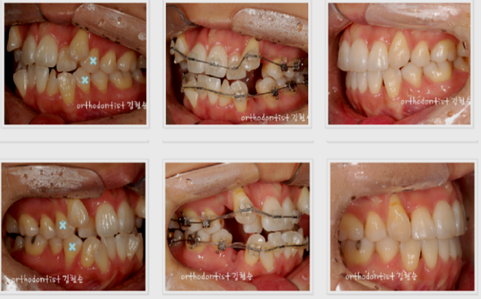강남 덧니 관련 이미지 13