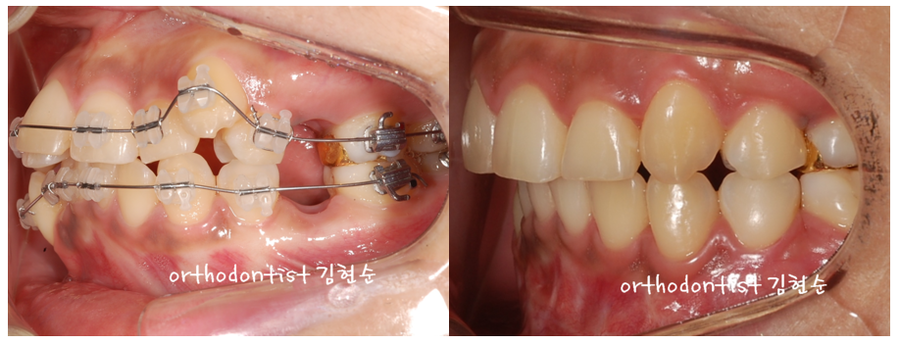 발치 교정으로 덧니 치열 올바로 잡기 관련 이미지 8