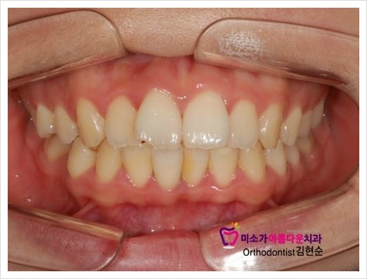 세라믹치과 돌출입교정치과 관련 이미지 1