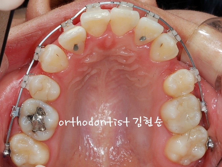 학동역치과 돌출입교정 세라믹치과에서 ~ 관련 이미지 5