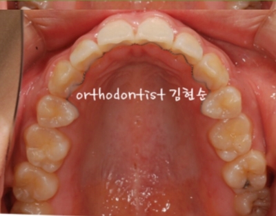 강남치아교정추천 관련 이미지 28