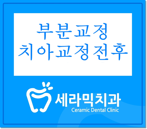 돌출입 앞니부분교정 치아교정전후 더 환해진 미소! 관련 이미지 1