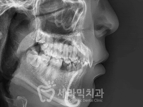 과개교합, 거미스마일, 치아 벌어짐까지 한번에! 치아교정전후 살펴보기 관련 이미지 6