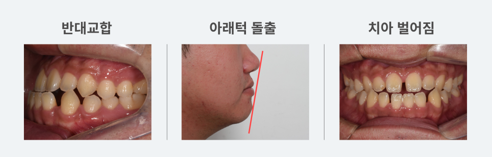치아가 반대로 물리는 관련 이미지 4
