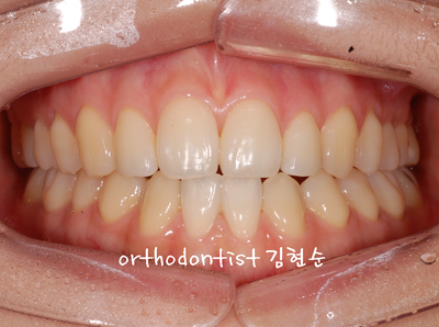 개방 교합 관련 이미지 26