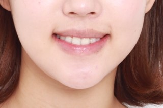 세라믹치과  교정리얼 스토리 관련 이미지 2