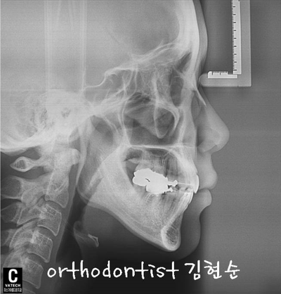 강남 돌출입 교정 관련 이미지 26
