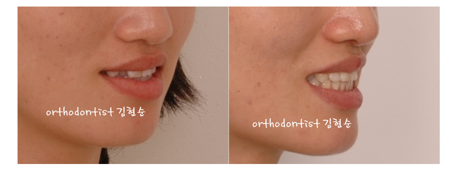 안면비대칭 교정, 치아교정만으로 간단히 해결하기 관련 이미지 18