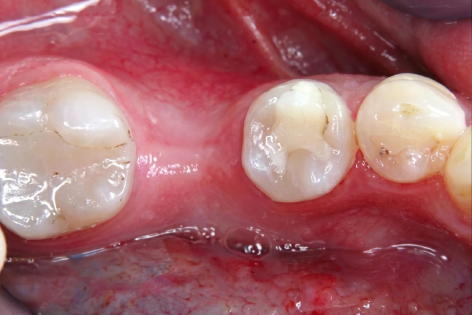 역삼동 치과, 임플란트 안 심고 살면 안 되나요? 관련 이미지 2