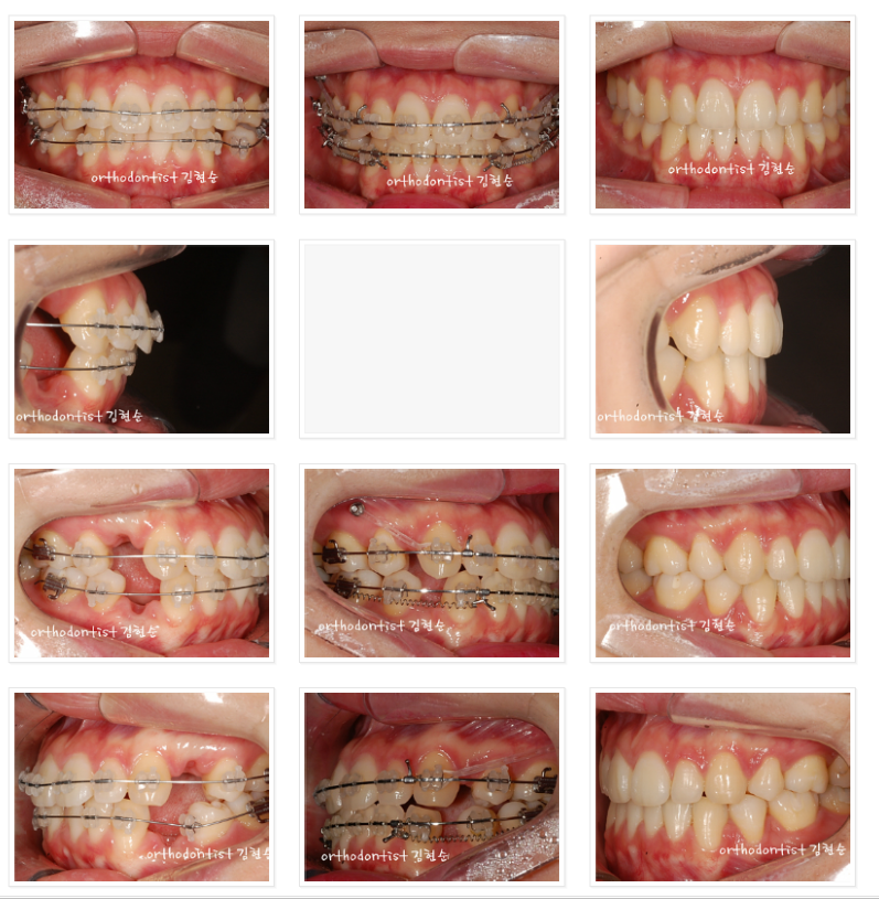 세라믹교정 세라믹치과-돌출입 발치교정 11 관련 이미지 3