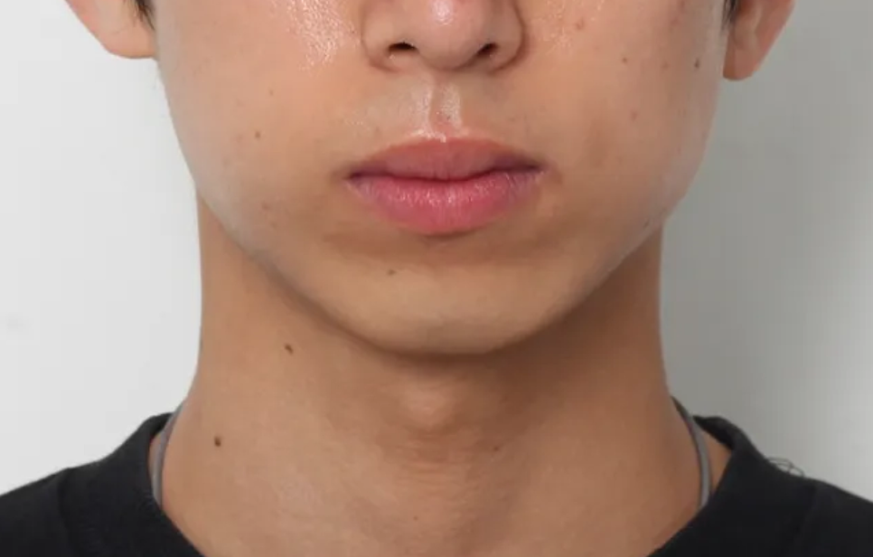 돌출입 교정 전후, 그런데 과개교합까지 있으셨던 환자분 관련 이미지 5