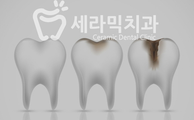 치아교정 부작용 제대로 알기 2. 관련 이미지 4