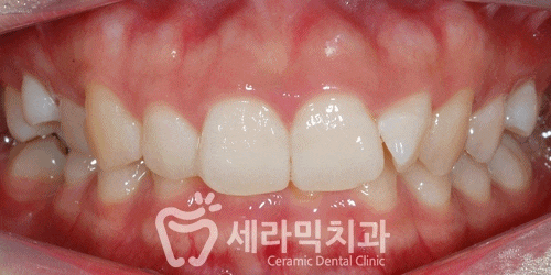 딥바이트(과개교합) 때문에 감추고 싶던 치아, 치아교정전후 달라진 미소 관련 이미지 7