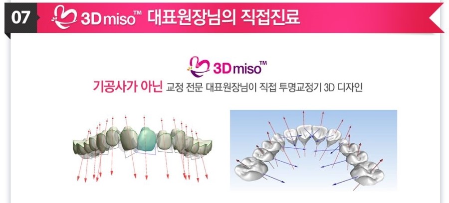 [ 학동역 치과 ] 투명교정의 새이름 3D miso 교정 관련 이미지 9