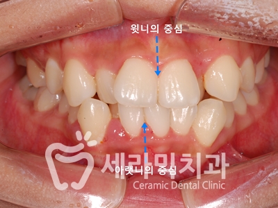 토끼이빨, 틀어진 치아배열 세라믹교정 전후사진 관련 이미지 5