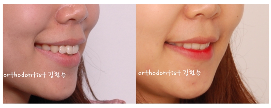 세라믹교정 은 세라믹치과 돌출입발치 관련 이미지 7