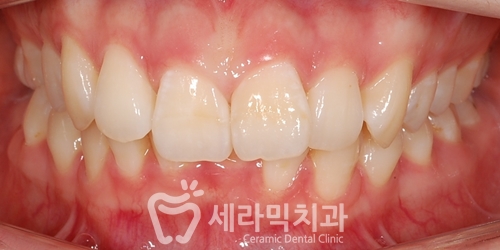 돌출입교정은 무조건 4개 발치교정? NO! 옥니 없는 돌출입치아교정 관련 이미지 2
