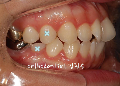 강남 돌출입 교정 관련 이미지 9