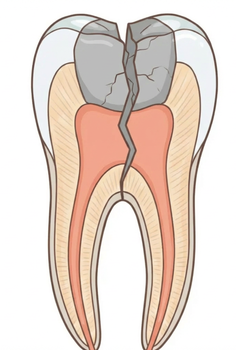 강남역 신경치료 후 크라운 꼭 해야하나요? 관련 이미지 4