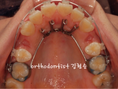 강남치아교정추천 관련 이미지 13