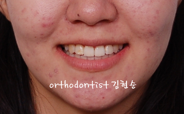 강남 돌출 관련 이미지 25