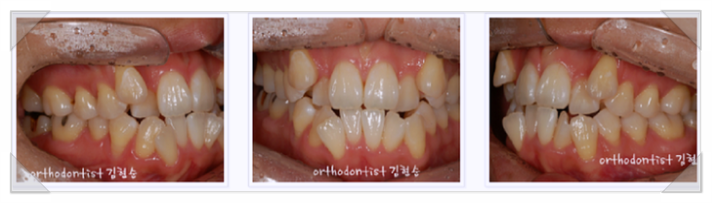 강남 덧니 관련 이미지 7