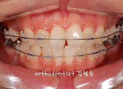 강남 돌출입 교정 관련 이미지 12