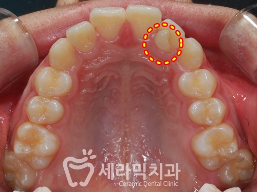 청소년교정 10대교정 딥바이트 과개교합 치아교정전후 관련 이미지 6