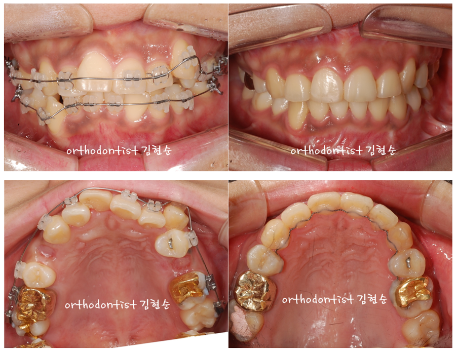 발치 교정으로 덧니 치열 올바로 잡기 관련 이미지 6