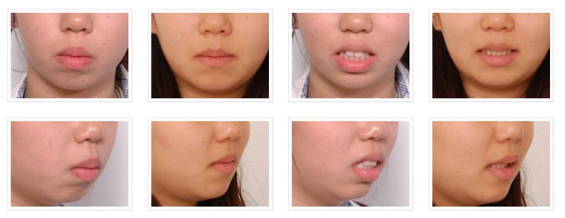 미니스크류를 이용한 발치 돌출입 교정, 무턱 개선 관련 이미지 9