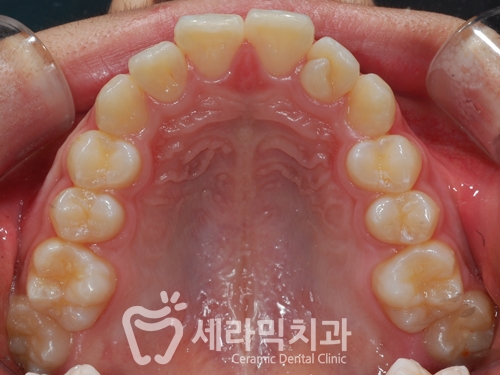 청소년교정 10대교정 딥바이트 과개교합 치아교정전후 관련 이미지 5