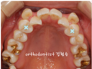 강남 덧니 관련 이미지 5