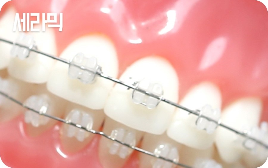 교정장치 구분하기 관련 이미지 11