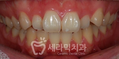 앞니 돌출, 개방교합으로 치아교정을 시작했는데, 작았던 아래턱이 커졌어요! 관련 이미지 6