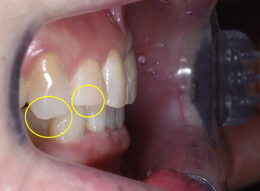 강남구청역 치과, 70대 외국인 환자의 라미네이트 관련 이미지 4