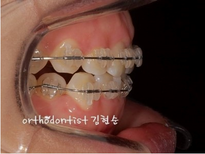 강남 과개 교합 관련 이미지 8