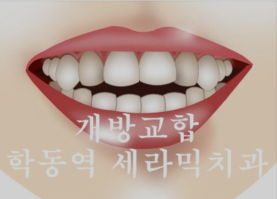 주걱턱 비수술 치아교정 잘하는 학동역 세라믹치과 관련 이미지 3