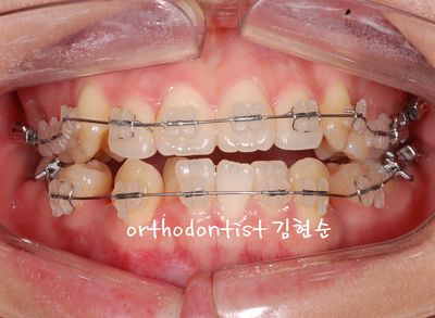 치열 교정(치열 불규칙) 관련 이미지 20