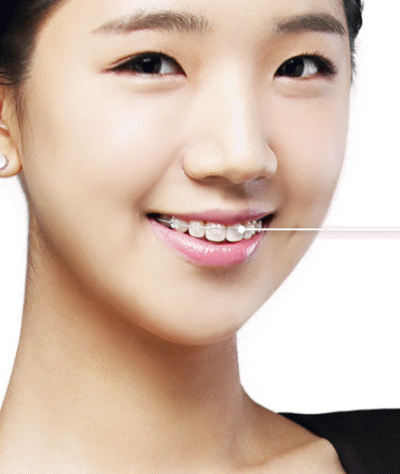 세라믹치과 3M 클래러티 어드밴스 치아교정 전속모델 콘테스트 관련 이미지 5