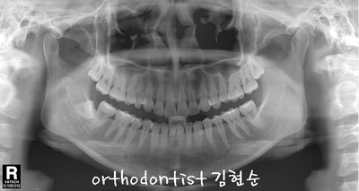 돌출 교정 (비발치 교정/비대칭) 관련 이미지 13