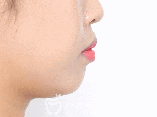 돌출입 투명교정으로 세련된 옆라인을 완성한 치아교정전후 관련 이미지 4