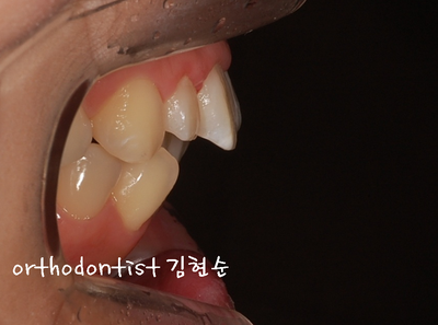 강남 돌출 관련 이미지 5