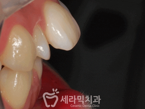 돌출입 치아교정전후 세련된 옆라인을 되찾다! 관련 이미지 2
