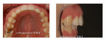 과개교합 ABP 교정 관련 이미지 9