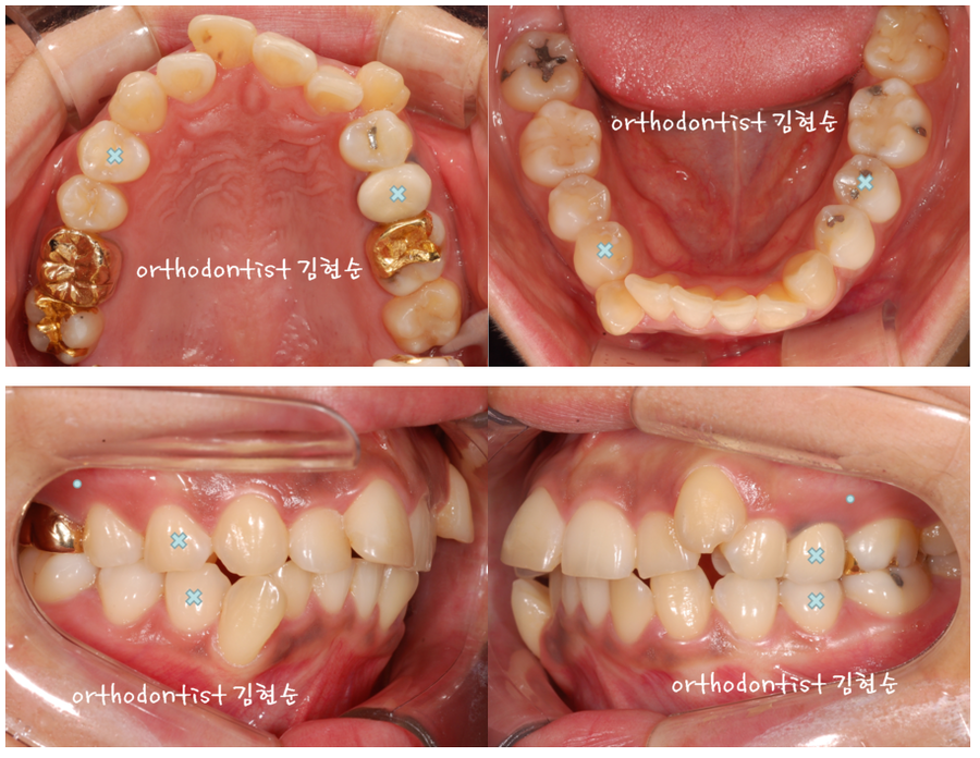 발치 교정으로 덧니 치열 올바로 잡기 관련 이미지 5